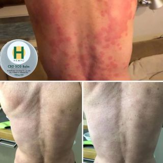 Nezapomínejme na HEMPE SOS Balzám! 💚 Kamarádova žena se vrátila z Jižní Ameriky s vážnou vyrážkou 😢 — po 36 hodinách a pár...